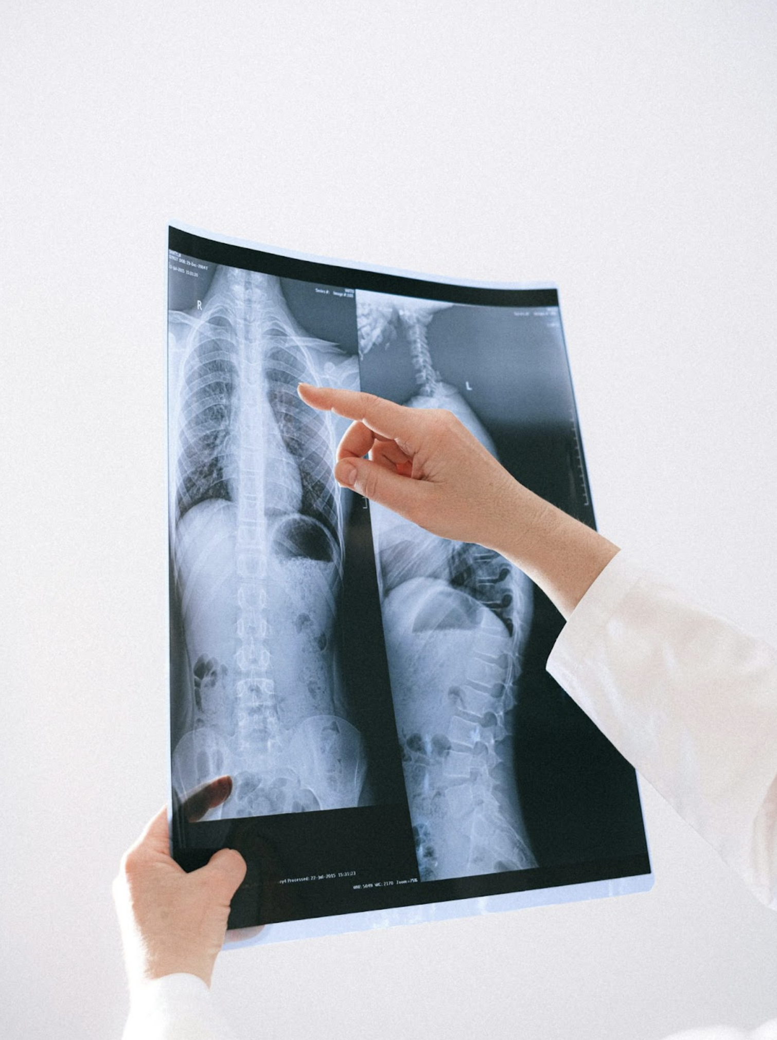 Who Is a Candidate for Laminectomy Surgery?